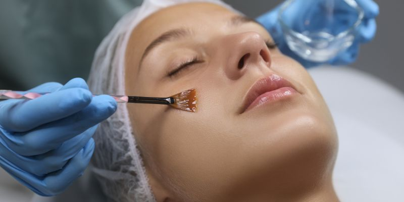 chemical-peel chemical-peel