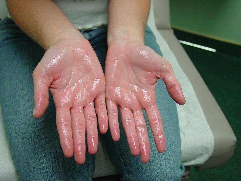 hyperhidrosis-treatment hyperhidrosis-treatment