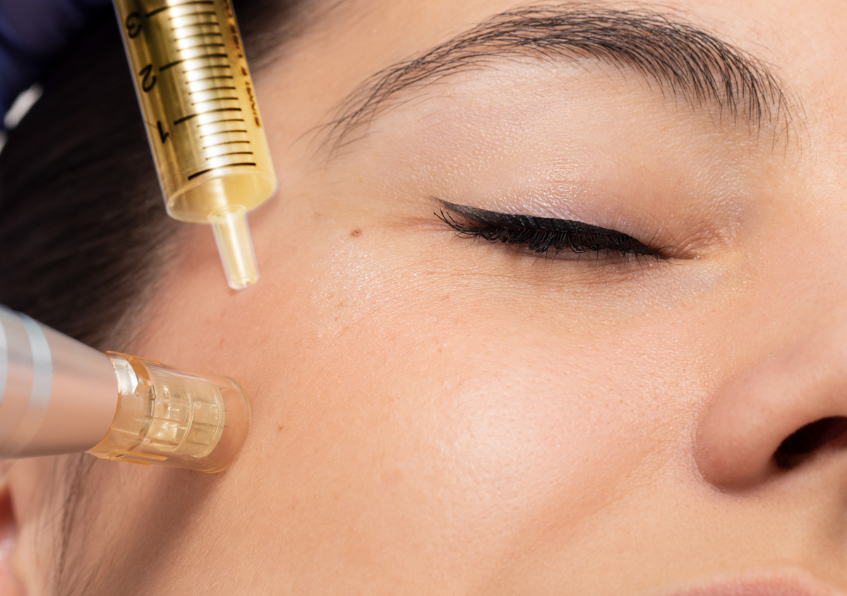microneedling-with-prp microneedling-with-prp